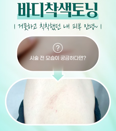 피코바디착색토닝 안산피부과 닥터에버스
