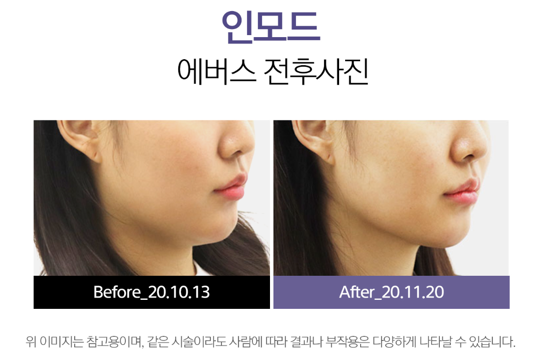 인모드FX 안산피부과 닥터에버스