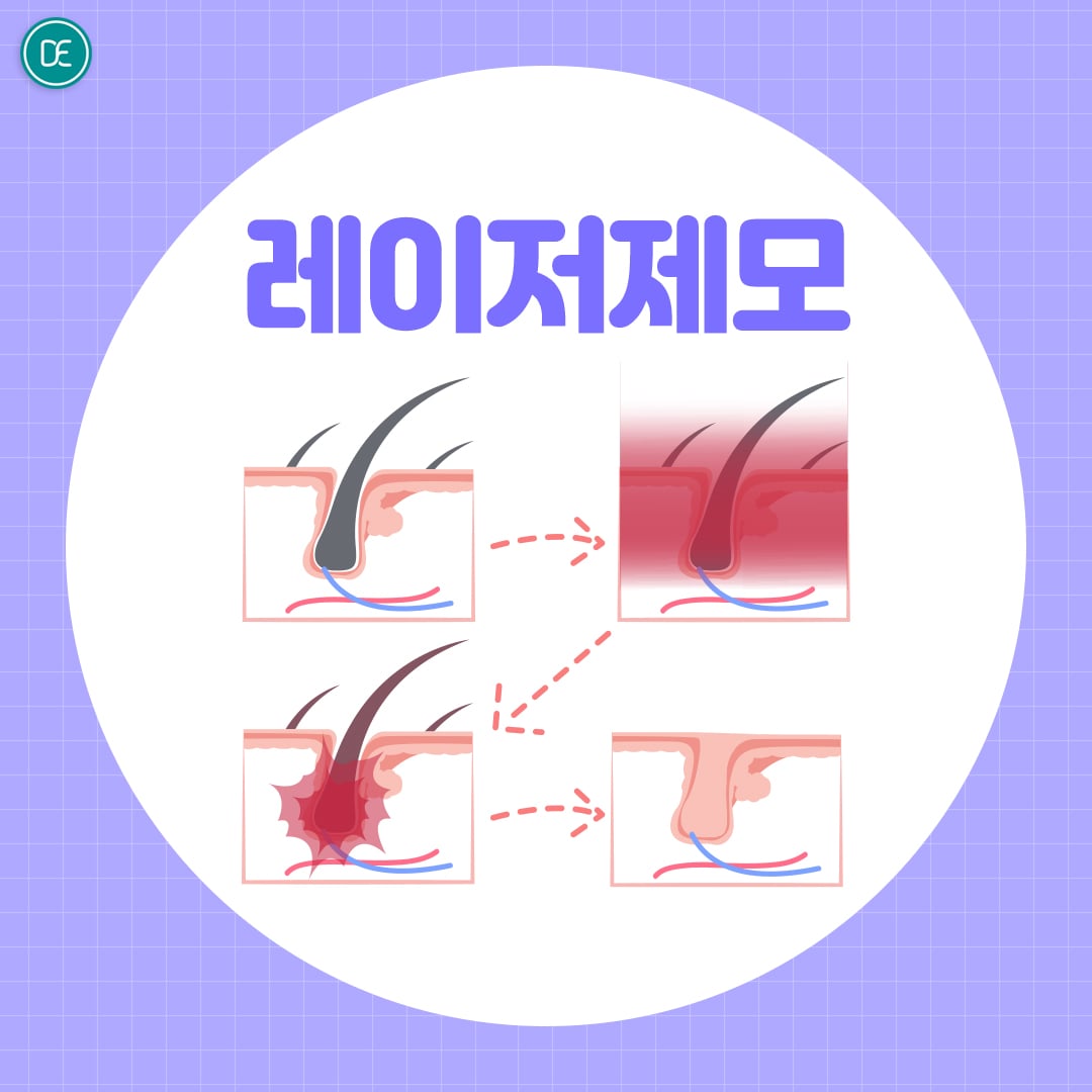 겨드랑이제모 바디착색토닝 안산피부과 닥터에버스