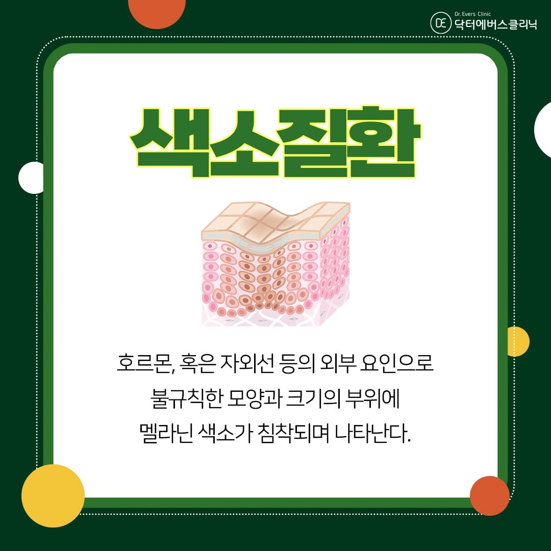 레이저